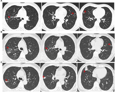 Diagnosis of mycobacterium avium complex infection utilizing metagenomics next-generation sequencing: a case report